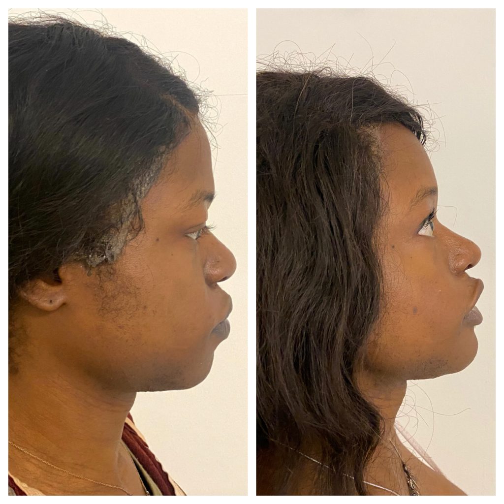 Chin Before and After